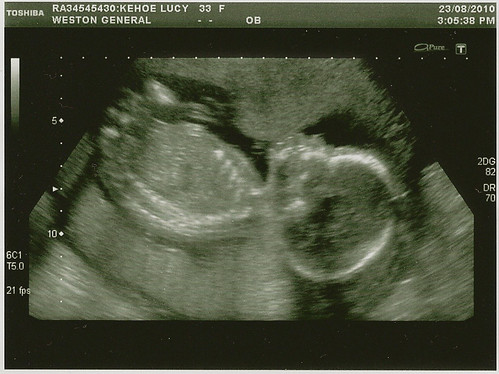 Baby Scan 20 Weeks #3